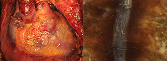 Comparative human and beetle heart