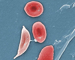 Sickle cell anemia