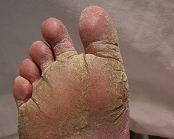 Athlete's foot tinea pedis