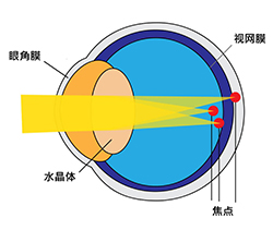 Astigmatism 