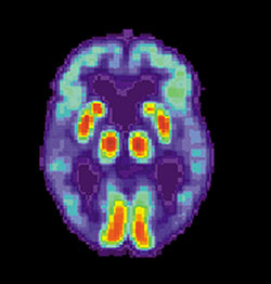 PET scan of a brain with Alzheimer's disease