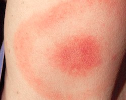 Lyme disease bullseye