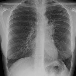 Lungs infected with TB