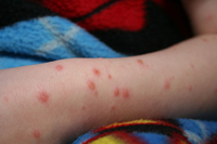 chicken pox