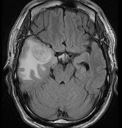 Glioma