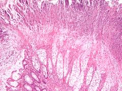 Colitis with C. diff