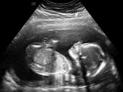 An ultrasound showing a blurry image of a fetus.