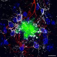 Colorized amyloid plaques with astrocytes and microglia