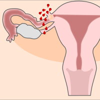 An illustration of a female reproductive system with a ruptured fallopian tube with red blood drops coming out of it