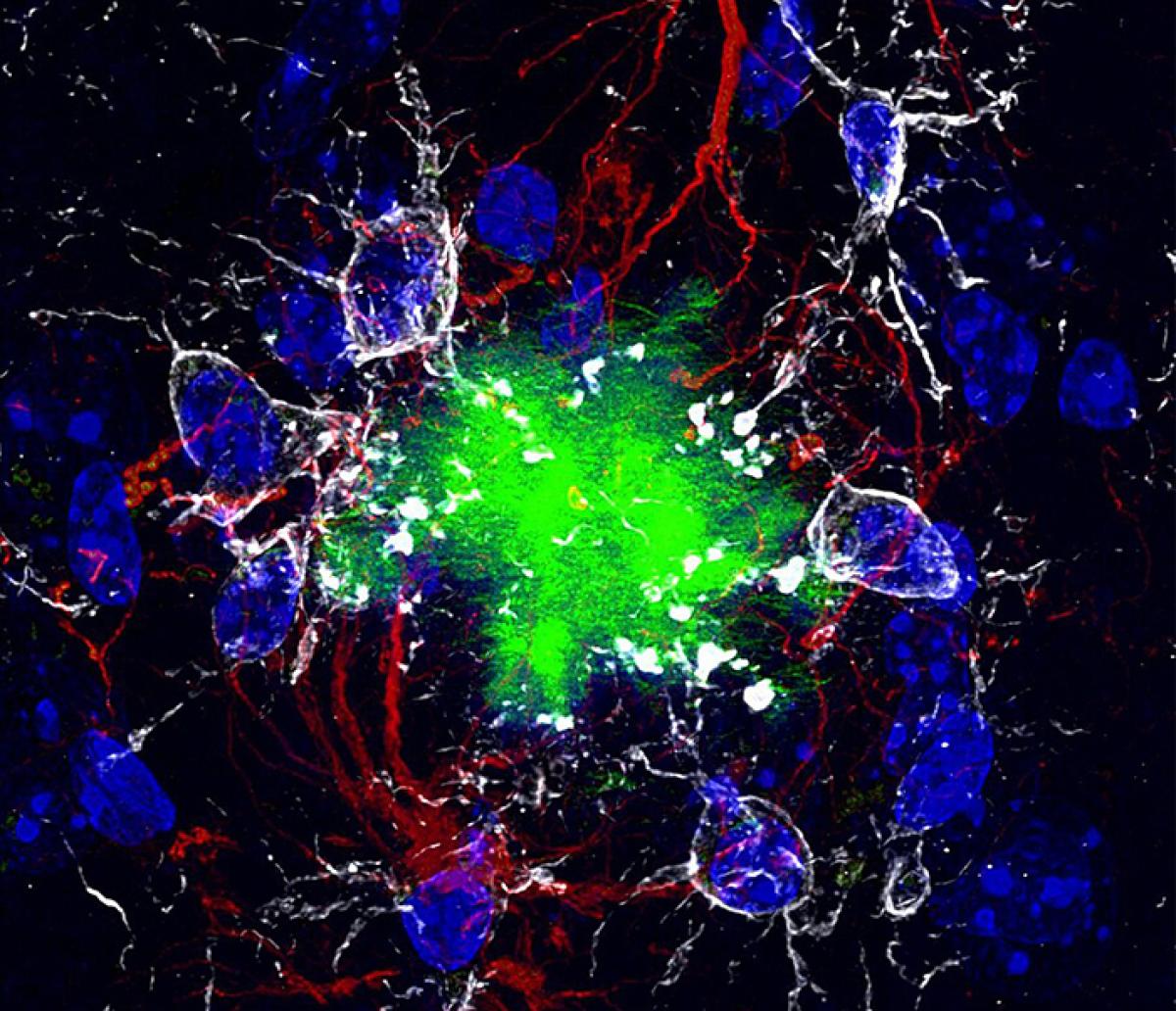 Colorized amyloid plaques with astrocytes and microglia