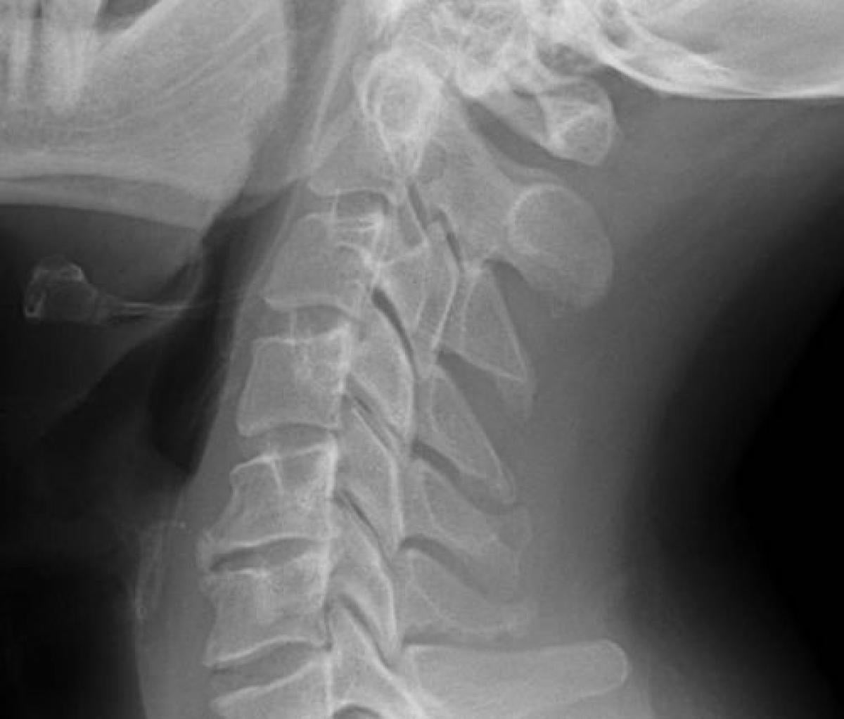 Cervical X-Ray