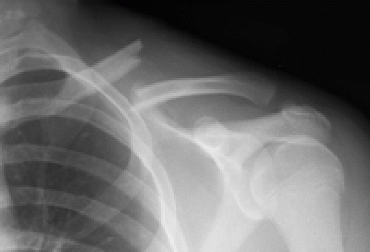 Clavicle fracture