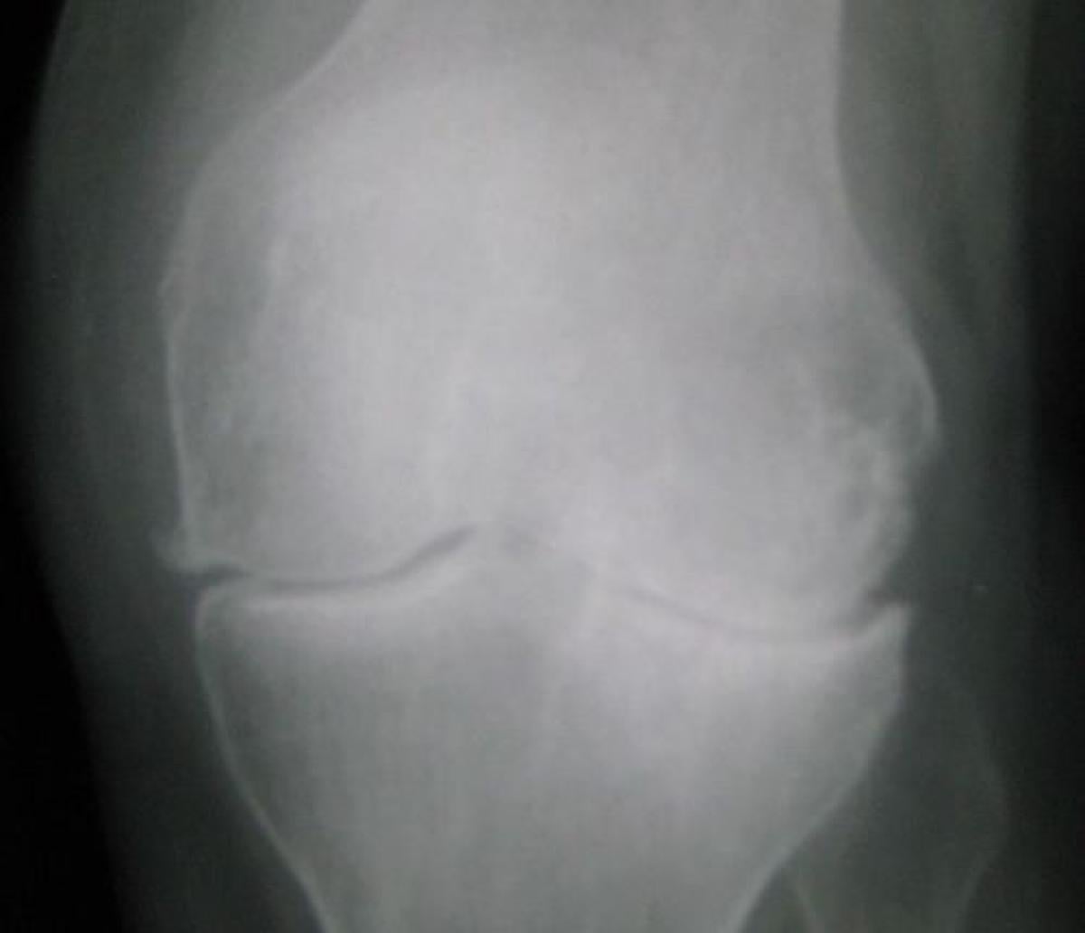 Osteoarthritic knee